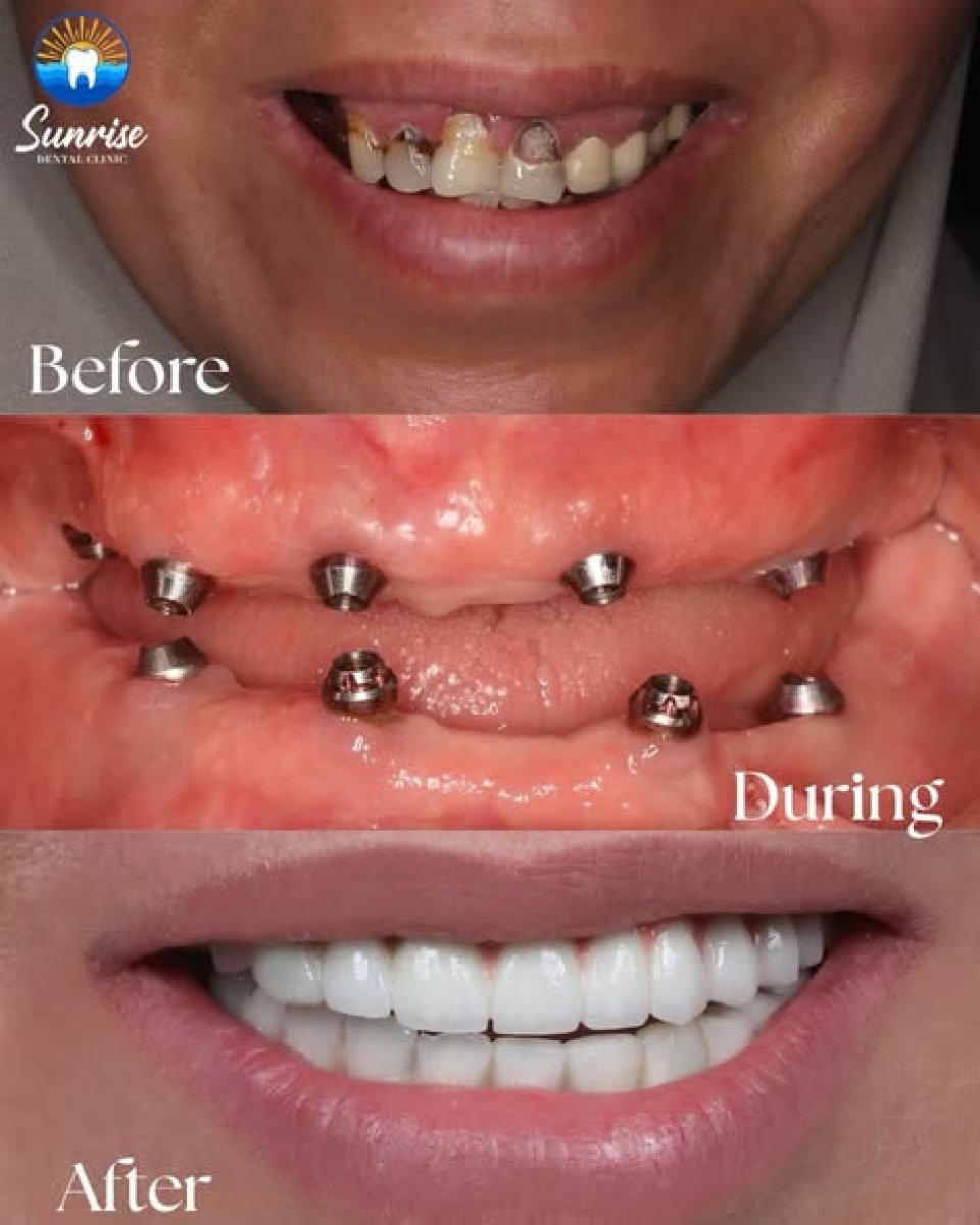 All-on-4 dental implants before and after results at Sunrise Dental Clinic, full smile restoration