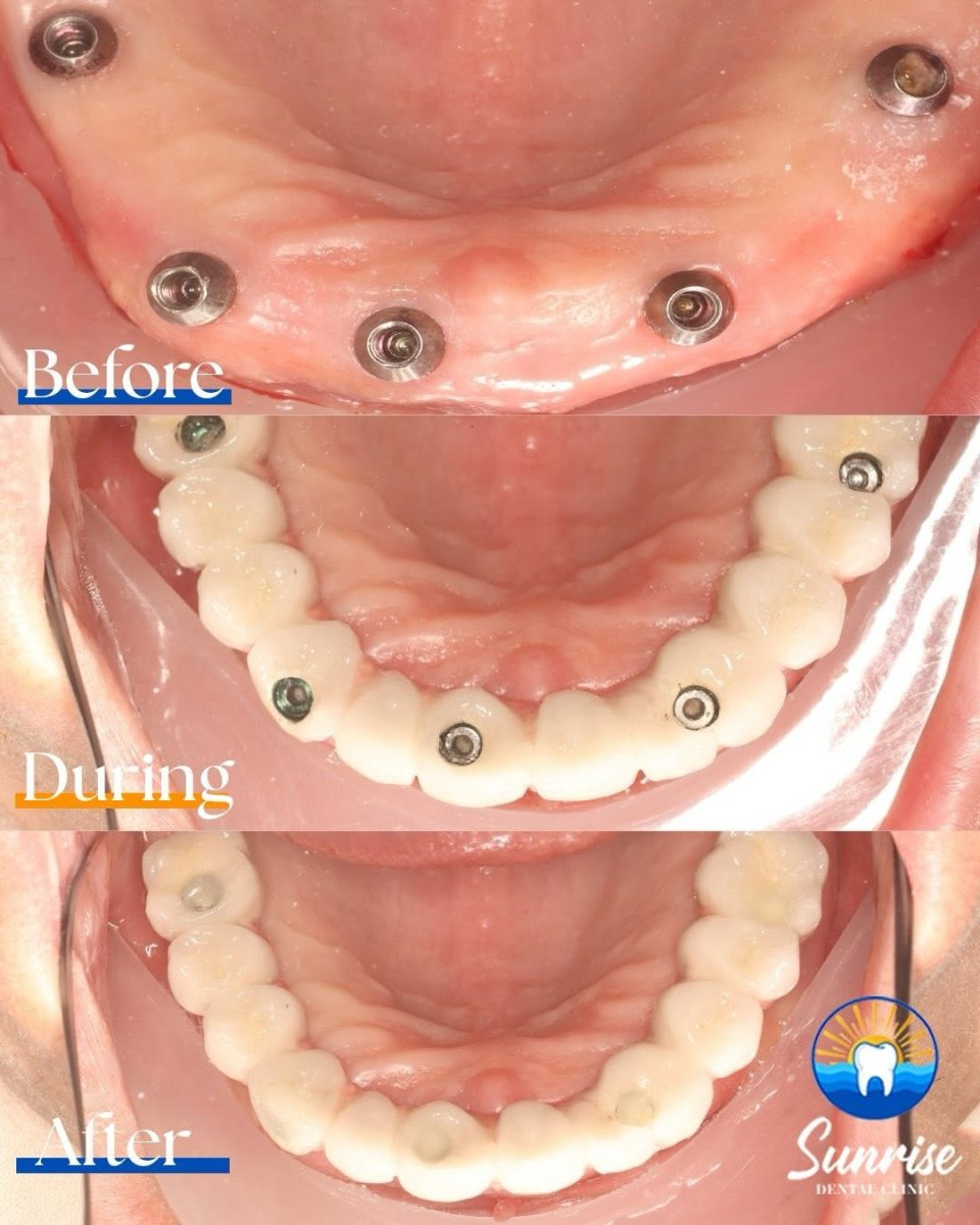 All-on-4 dental implants before and after result at Sunrise Dental Clinic – full lower arch restoration