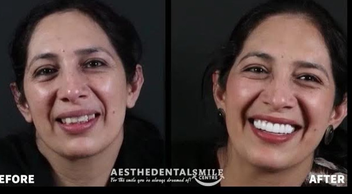 Голливудская улыбка до и после в клинике aesthedental — заметное преображение улыбки