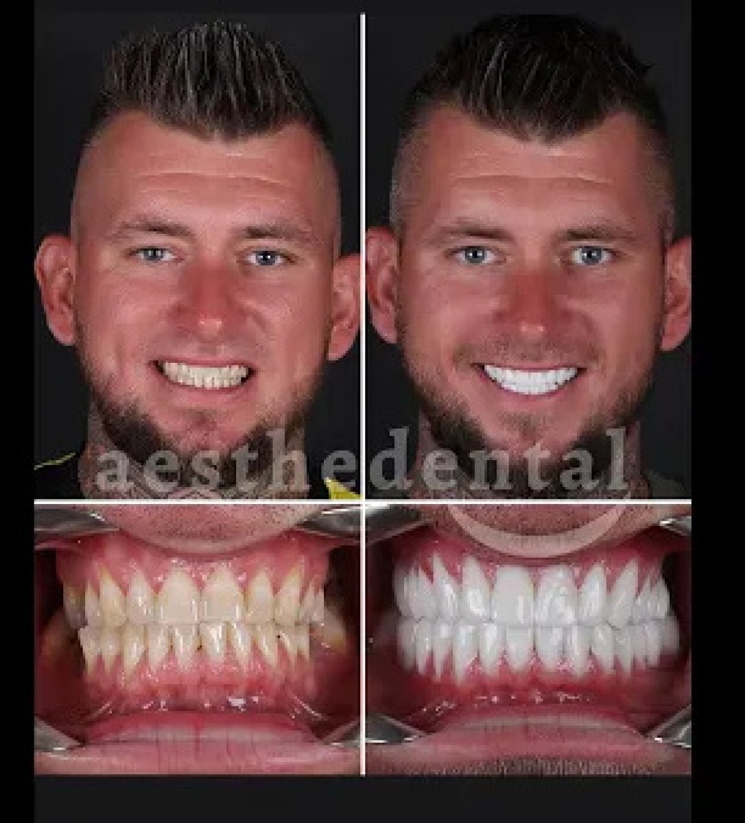 Результаты до и после Hollywood Smile в aesthedental Dental Clinic, белоснежные зубы