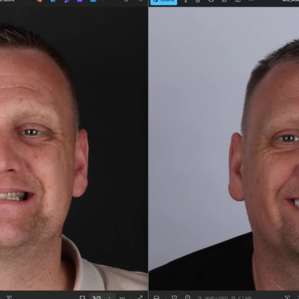 Résultats avant et après implant dentaire chez aesthedental Dental Clinic, sourire amélioré