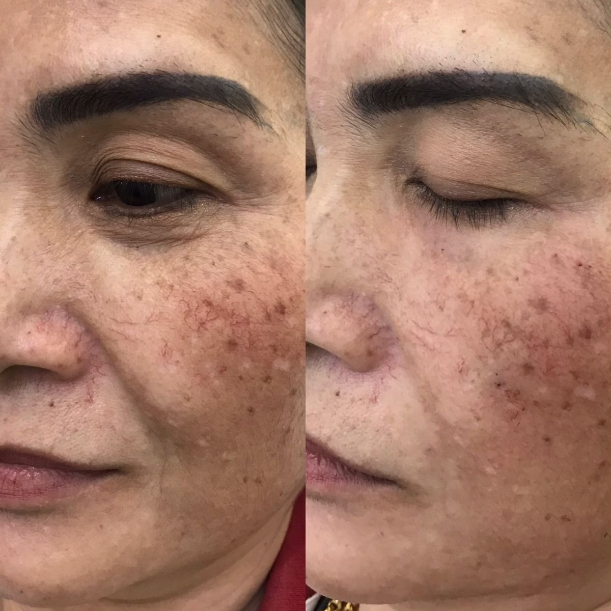 Antes y después de inyecciones de relleno en Asia Cosmetic Hospital, rejuvenecimiento facial visible