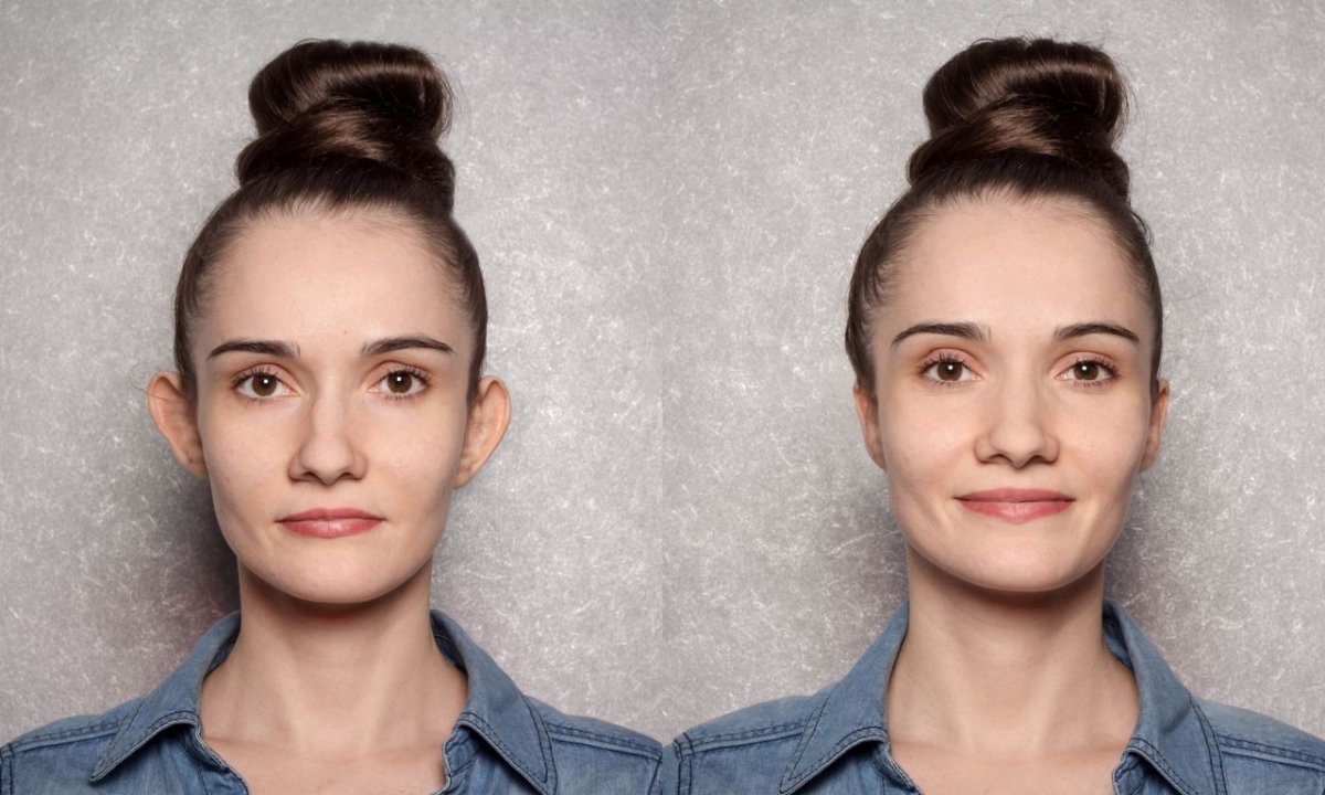 Résultats avant/après otoplastie chez Op. Dr. Evren Ay Koç, correction naturelle des oreilles
