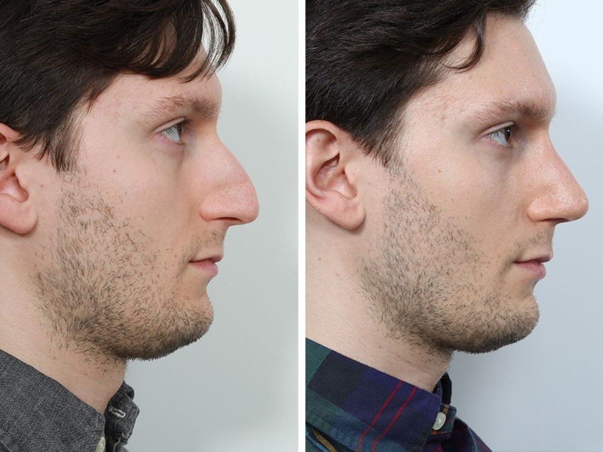 Before and after liquid rhinoplasty result at Op. Dr. Evren Ay Koç, non-surgical nose reshaping