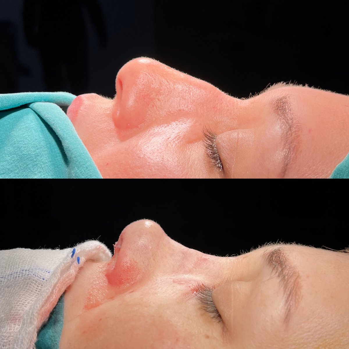 نتيجة قبل وبعد تجميل الأنف السائل في Op. Dr. Evren Ay Koç، تعديل الأنف بدون جراحة