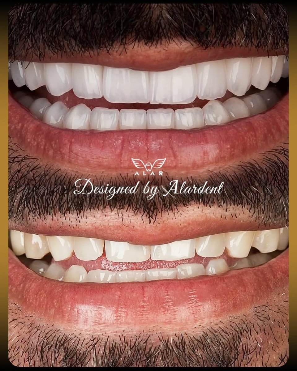 Before and after veneers at Alar Dent - Oral and Dental Health Clinic, smile makeover result