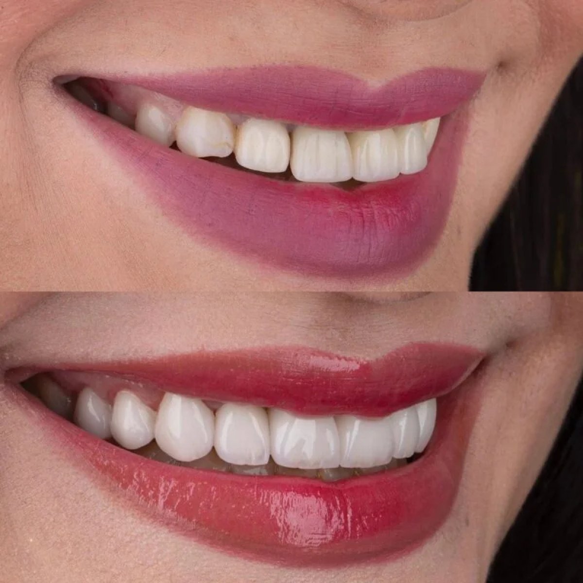 Resultados de blanqueamiento dental antes y después en Alar Dent - Oral and Dental Health Clinic