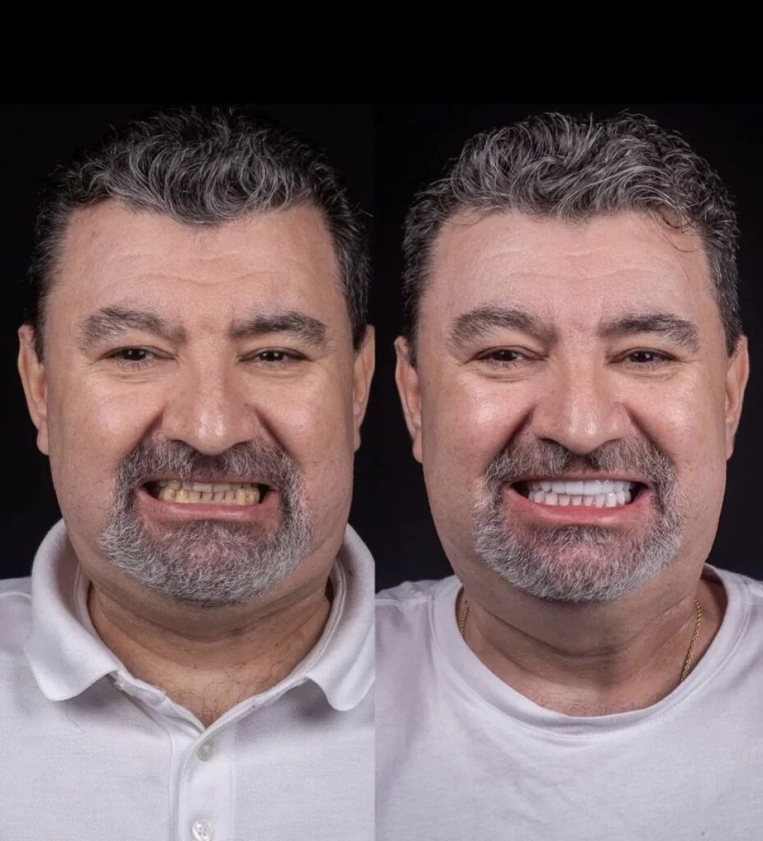 Resultados antes y después del blanqueamiento dental en Alar Dent - Oral and Dental Health Clinic
