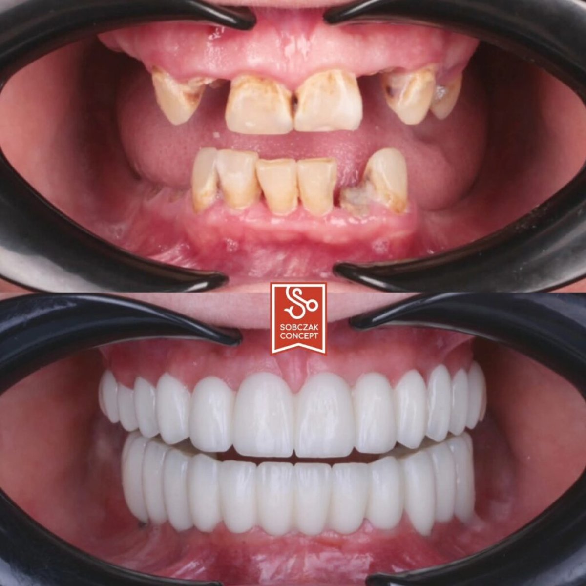 Vorher-nachher Veneers bei DR SOBCZAK KLINIKI – sichtbare Zahn- und Lächelverwandlung