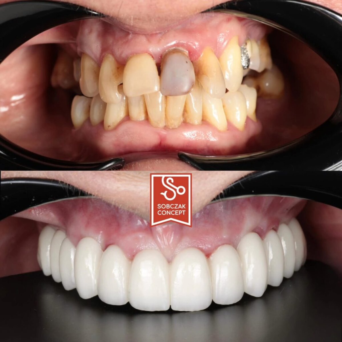 Antes y después de prótesis dentales en DR SOBCZAK KLINIKI, resultado de restauración de sonrisa