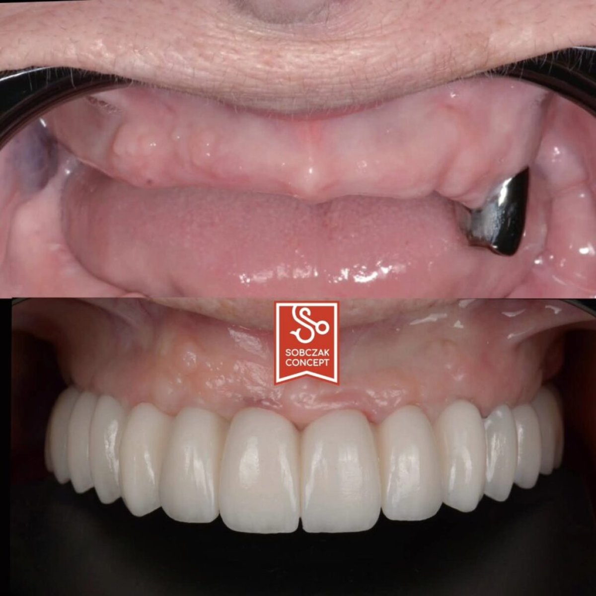 Resultados antes y después de prótesis dentales en DR SOBCZAK KLINIKI, restauración total de la sonrisa