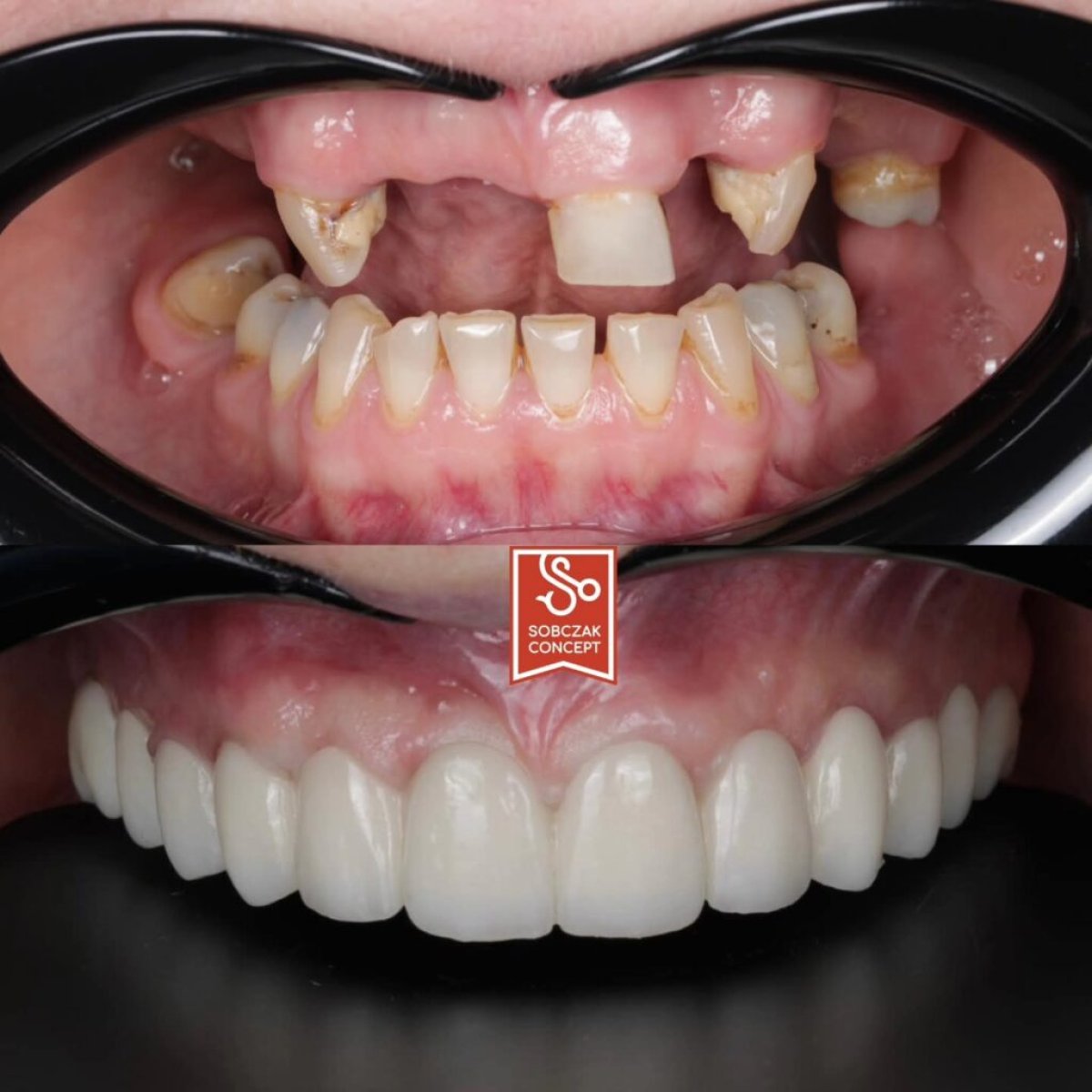 Before and after dental prosthetics installation at DR SOBCZAK KLINIKI, restored smile result