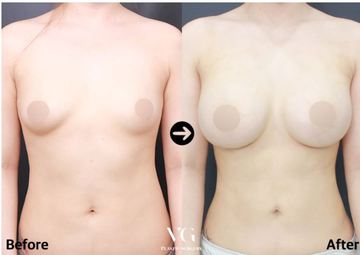 Before and after lipofilling breast augmentation results at VG Plastic Surgery clinic