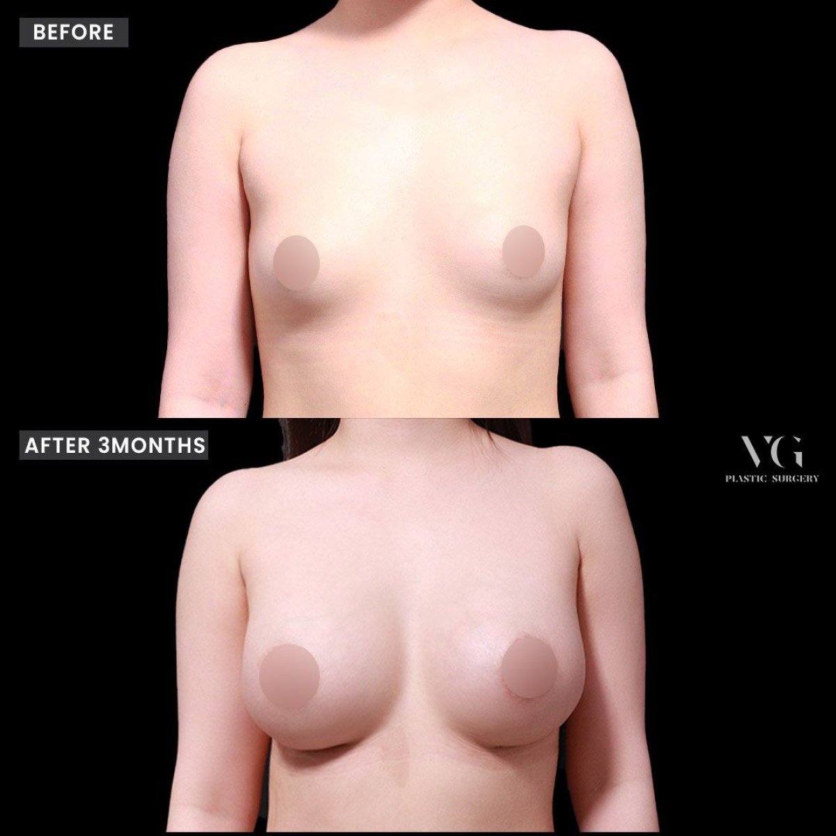 Before and after breast lipofilling results at VG Plastic Surgery, natural volume enhancement