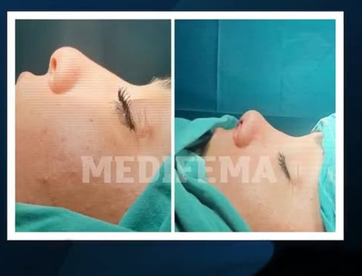 Before and after rhinoplasty results at Medifema Hospital, nose reshaping procedure outcome