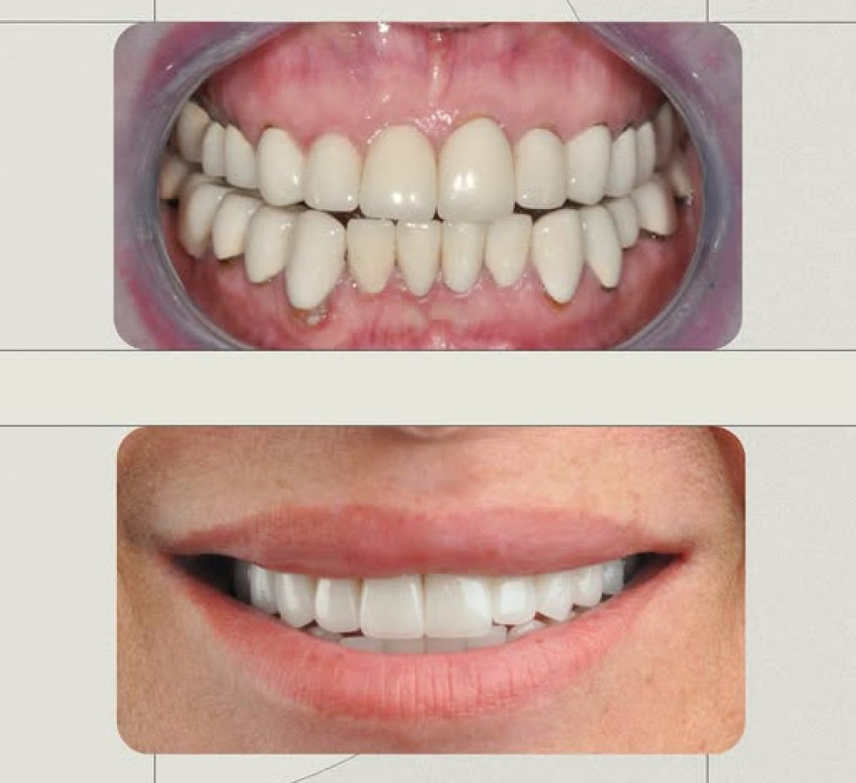 Efekty metamorfozy uśmiechu w Dera Dental Clinic – poprawa koloru i ustawienia zębów