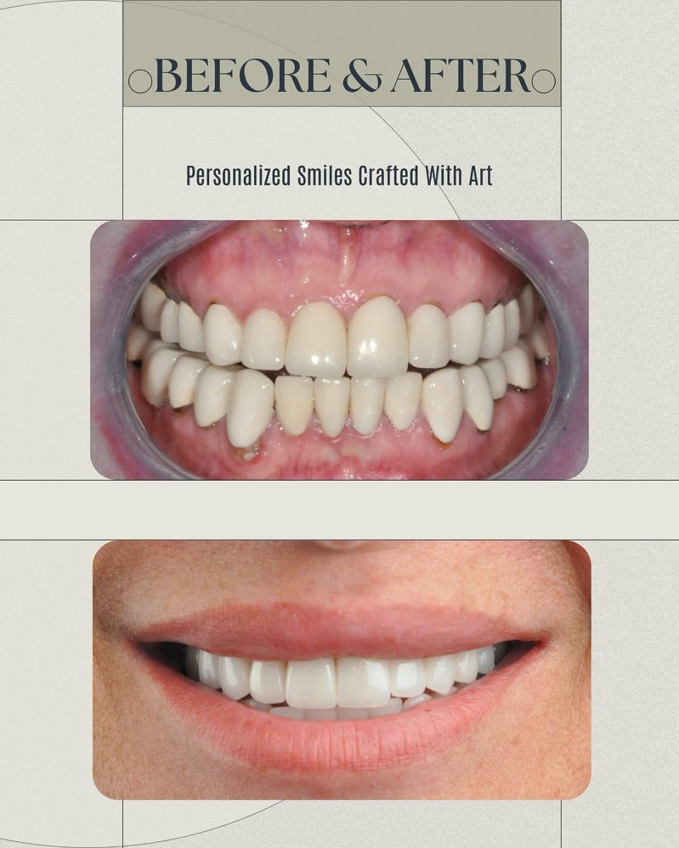 Efekty metamorfozy uśmiechu przed i po w Dera Dental Clinic – poprawa ustawienia zębów