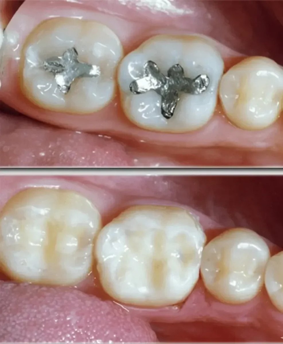 Before and after composite filling results at Dera Dental Clinic, metal fillings replaced