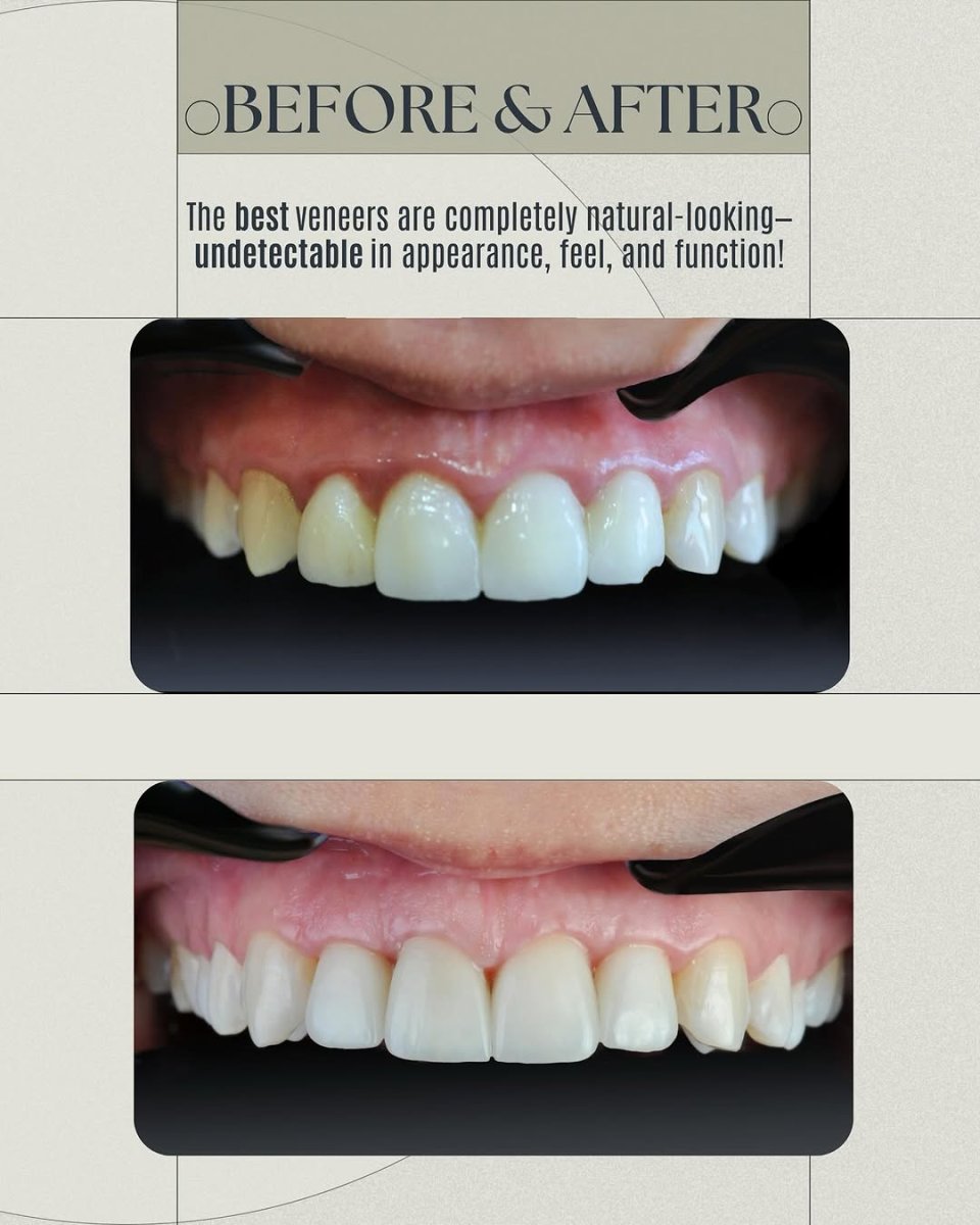 Efekty przed i po licówkach w Dera Dental Clinic – naturalna metamorfoza uśmiechu