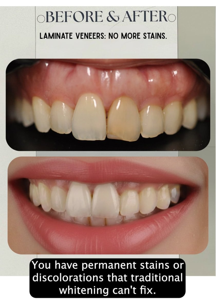 Before and after laminate veneers at Dera Dental Clinic – stain-free smile transformation result