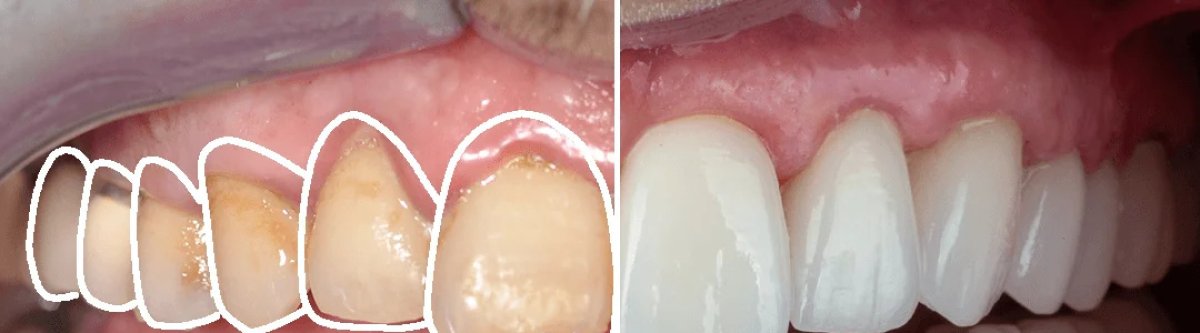 Before and after tooth whitening results at Dera Dental Clinic, visibly brighter smile