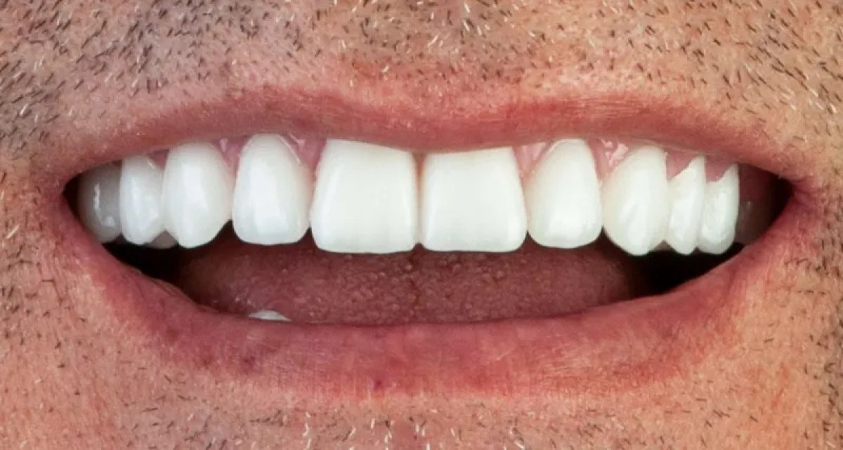 Efekt implantu zęba w Dera Dental Clinic – naturalnie wyglądający uśmiech