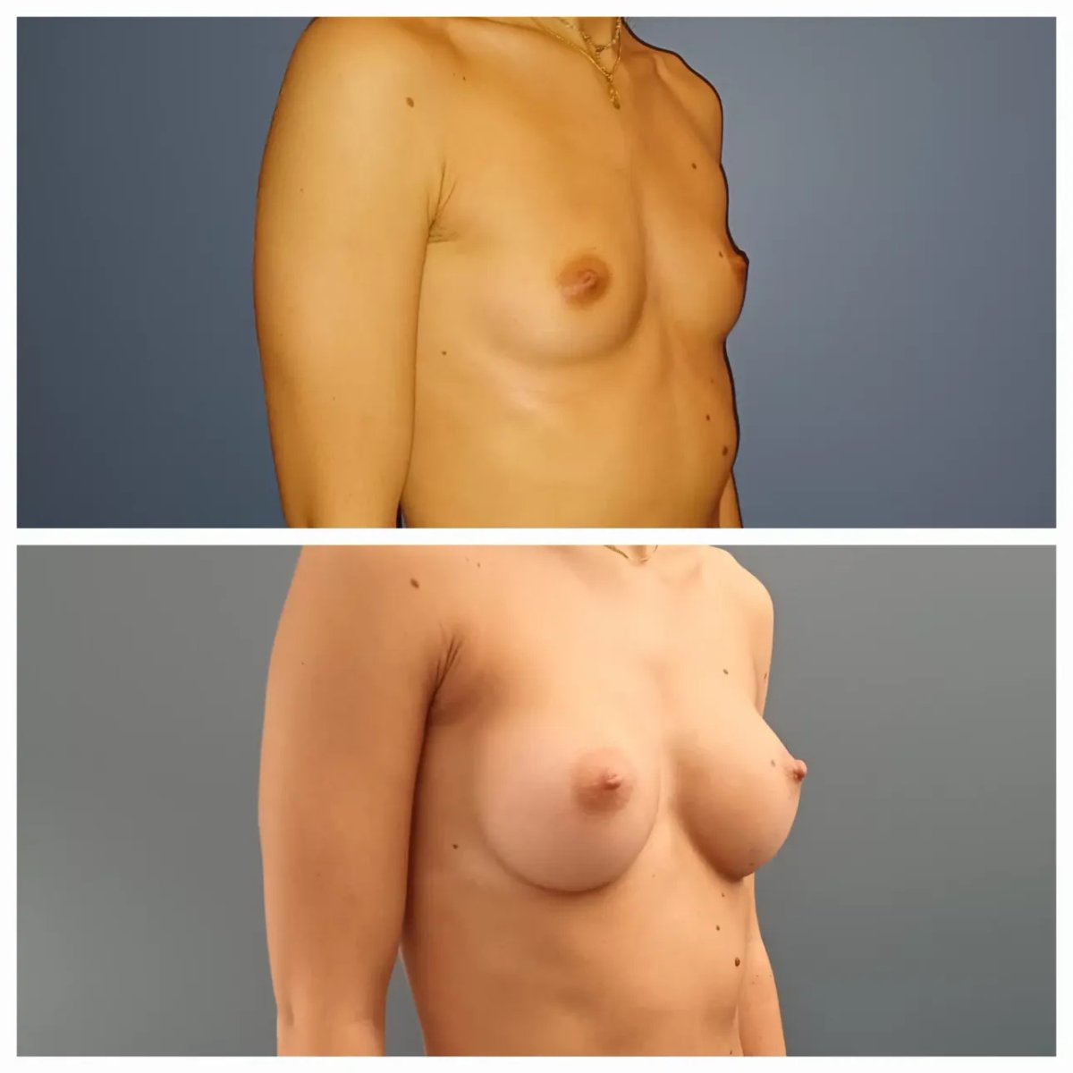 Before and after breast augmentation result at Docteur Samuel Struk clinic, fuller breasts