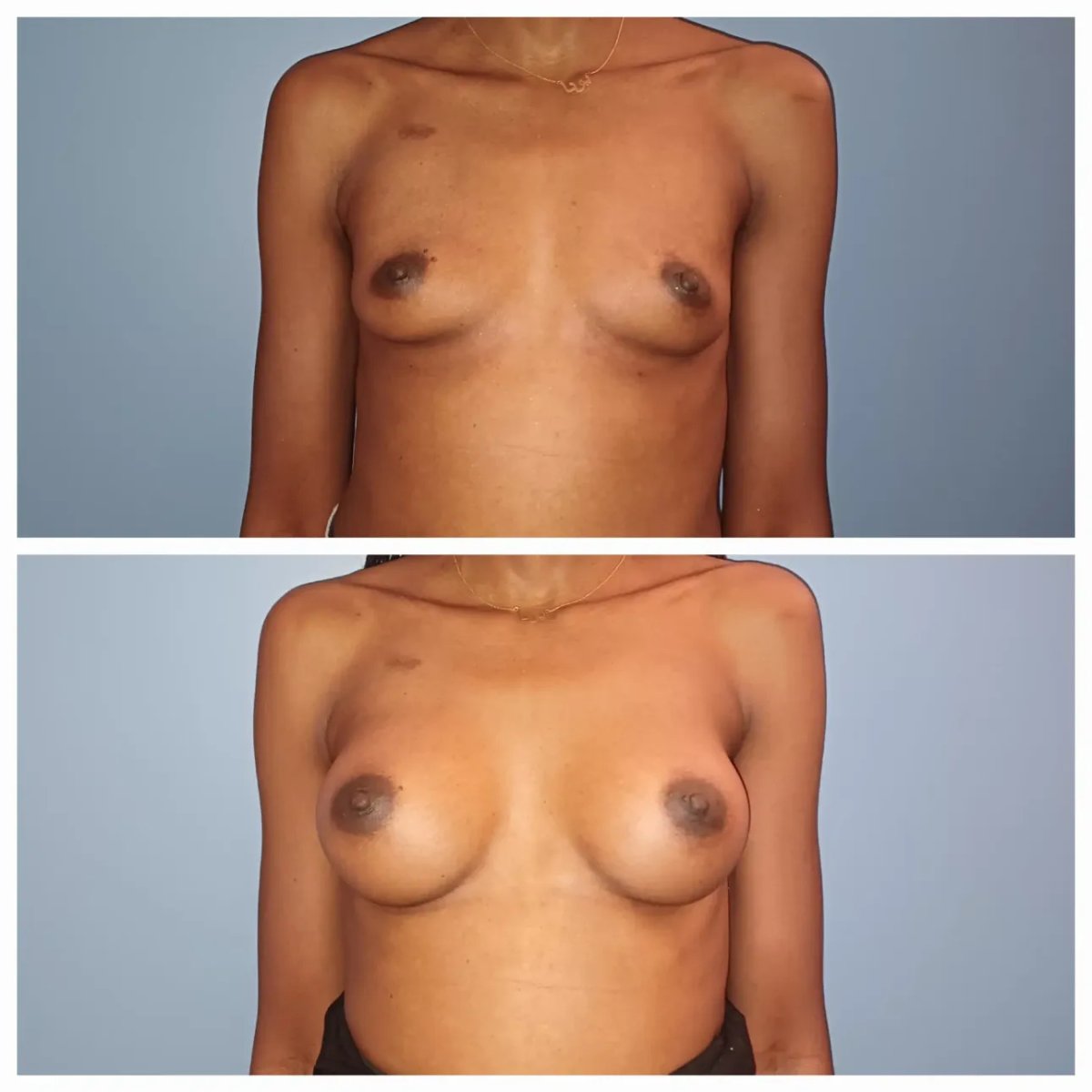 Before and after breast augmentation result at Docteur Samuel Struk clinic, fuller breasts