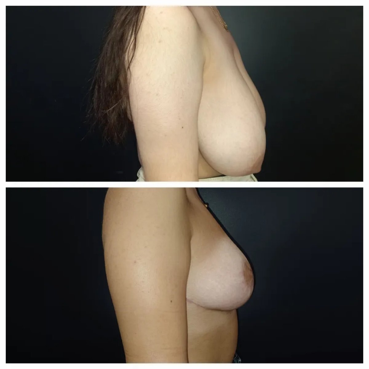 Before and after breast reduction results at Docteur Samuel Struk clinic, improved breast shape