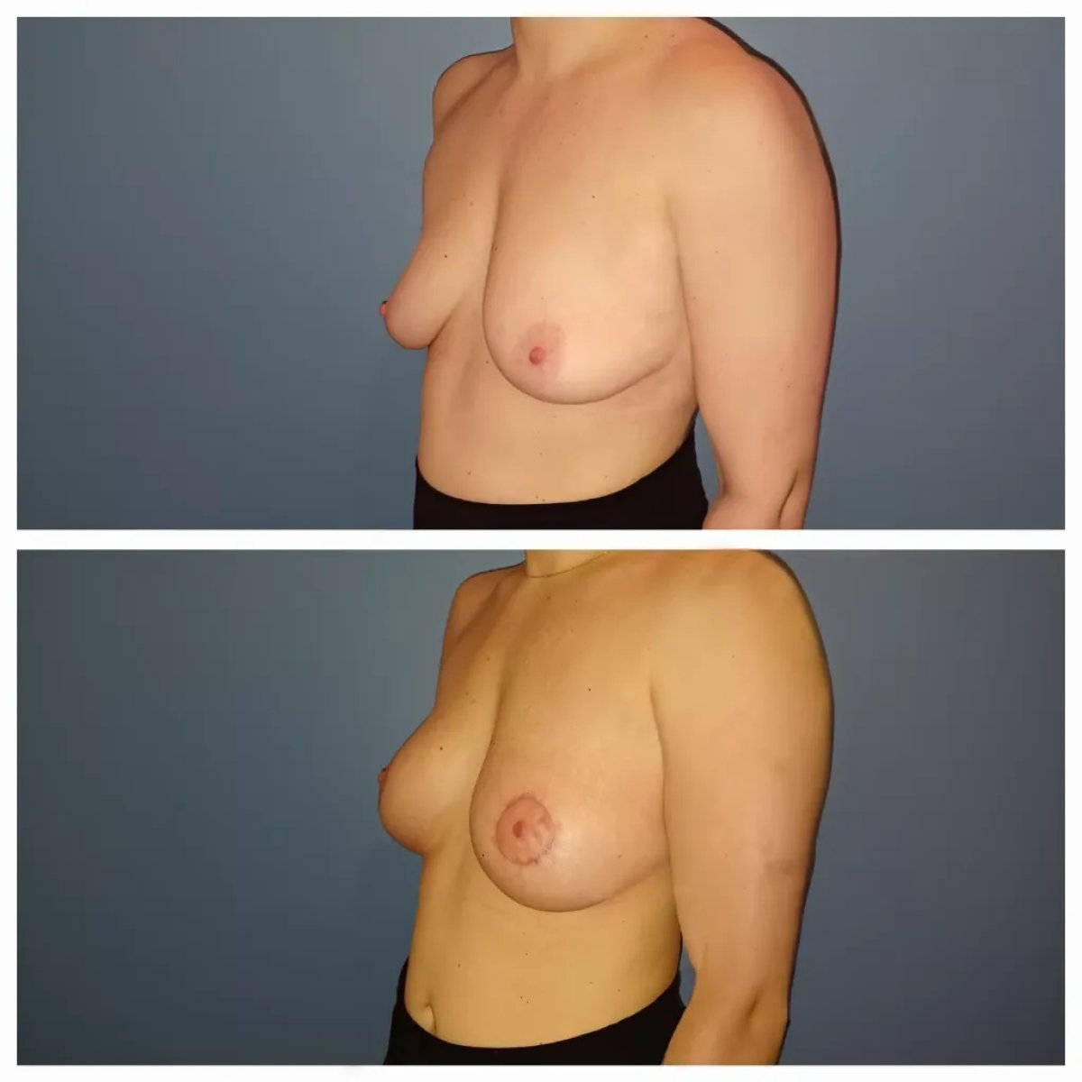 Before and after breast lift with round implants result at Docteur Samuel Struk clinic Paris