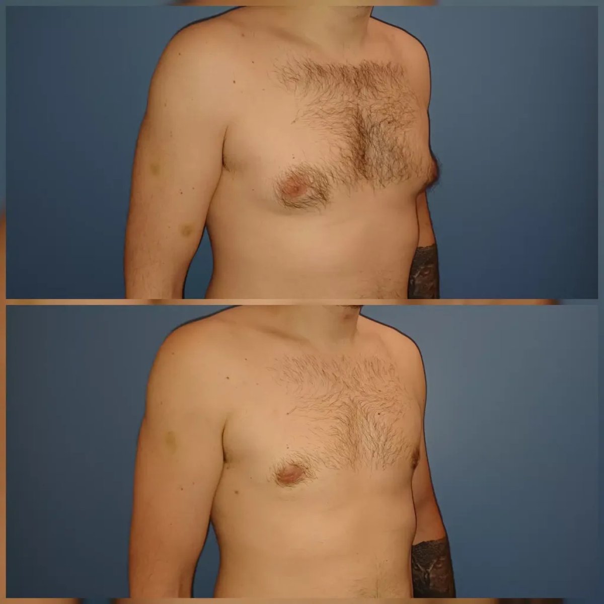 Before and after liposuction for gynecomastia at Docteur Samuel Struk, chest contour result