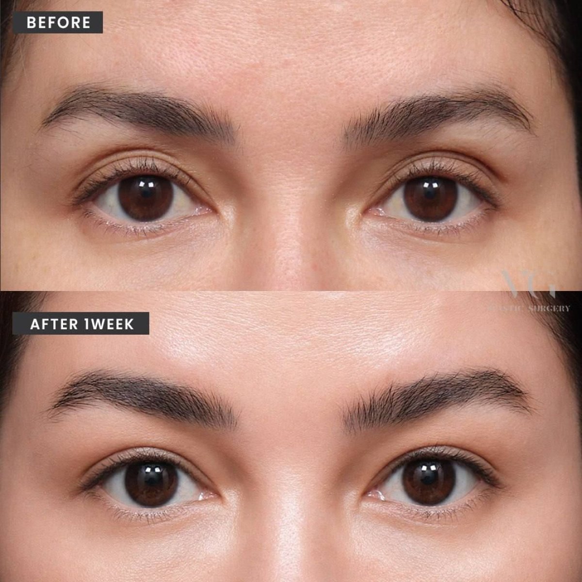Блефаропластика до и после в VG Plastic Surgery, результат коррекции век через 1 неделю
