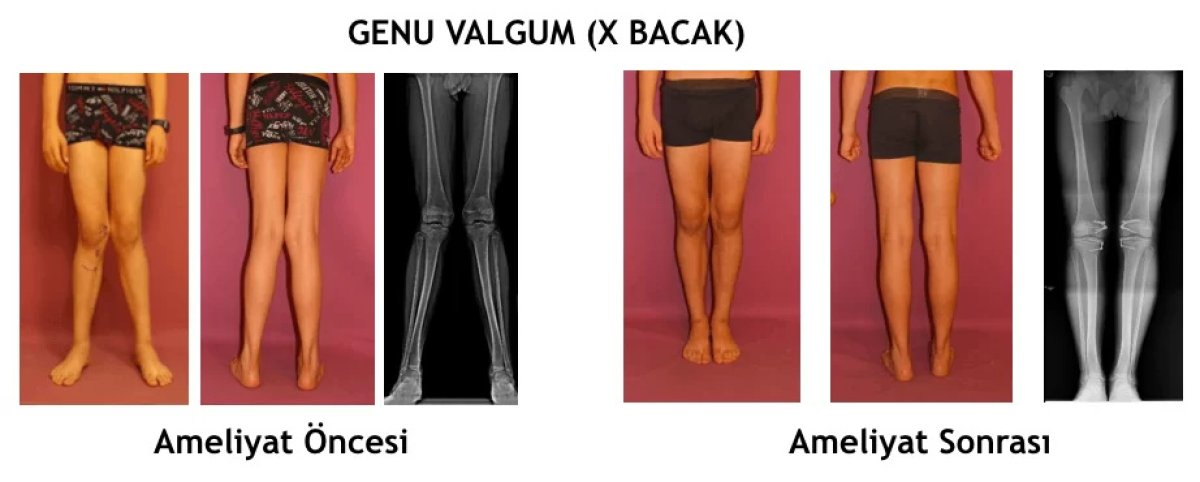 Before and after results of valgus deformity surgery at Ortopediatri, improved leg alignment