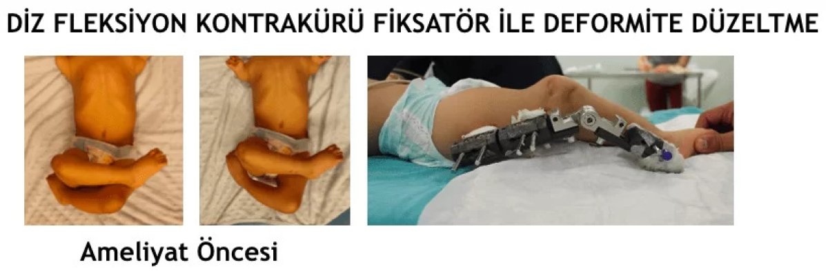Результаты до и после коррекции контрактуры колена фиксатором в Ortopediatri
