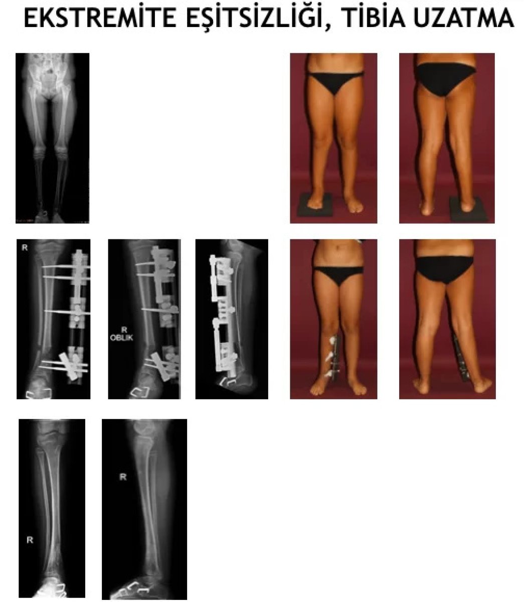 Resultados antes y después de alargamiento de tibia en clínica Ortopediatri