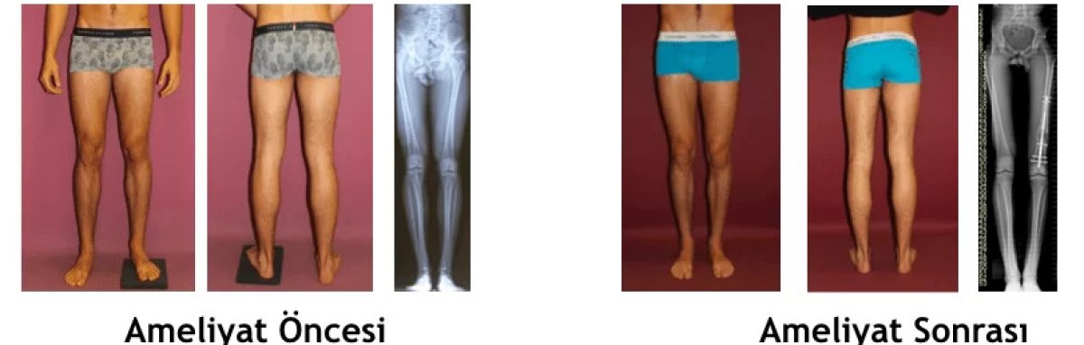 Before and after limb lengthening surgery results at Ortopediatri, improved leg alignment