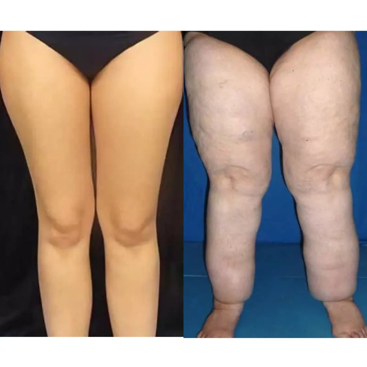 Résultats avant et après liposuccion des jambes à Premier Clinic, contour amélioré