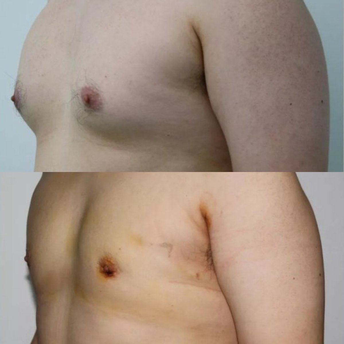 Resultados de liposucción de pecho masculino antes y después en Premier Clinic, contorno mejorado