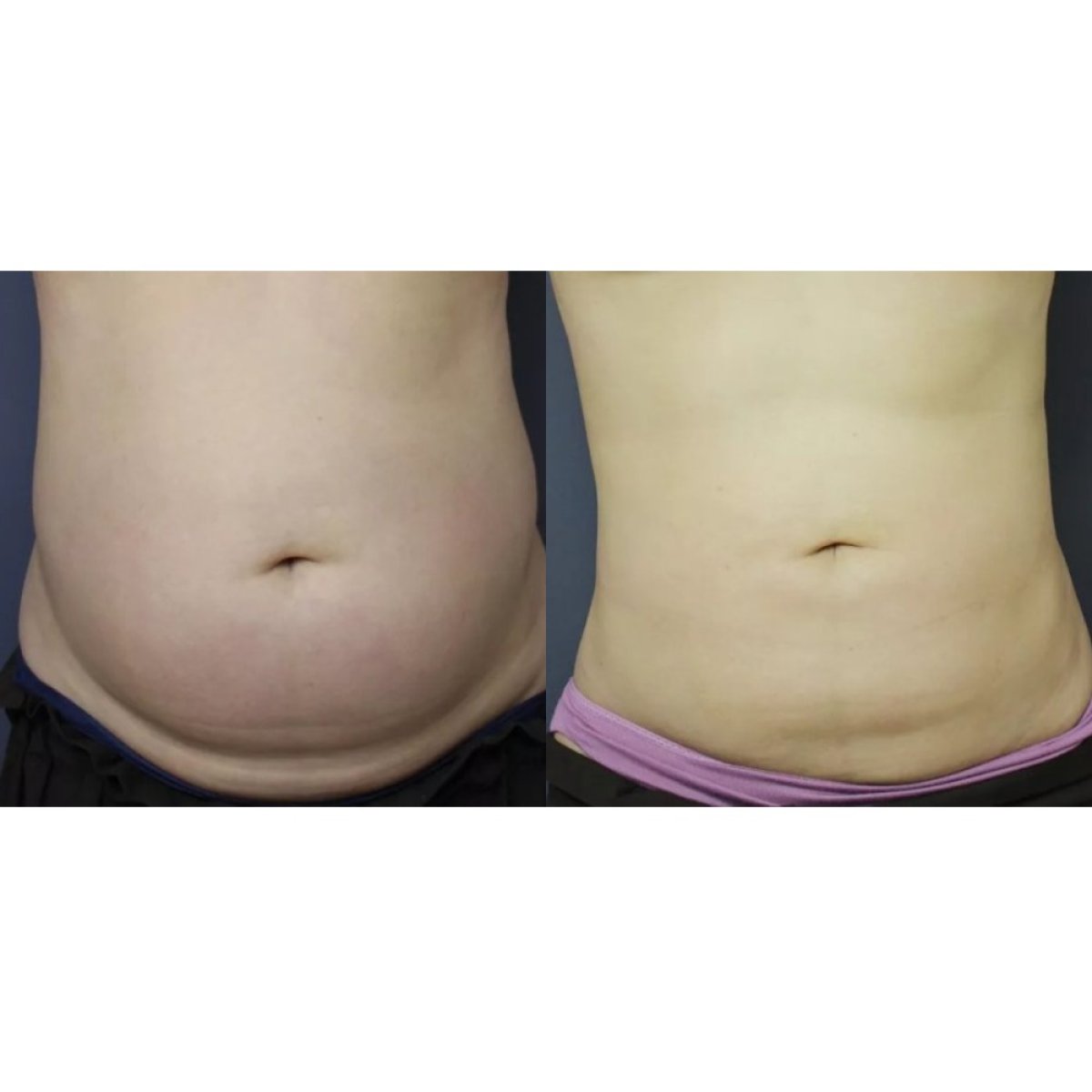 Avant et après liposuccion à Premier Clinic, résultat visible du remodelage abdominal