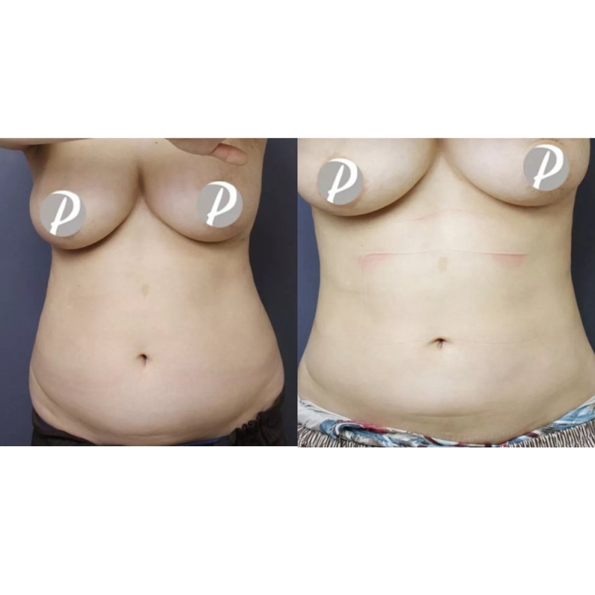 Before and after tumescent liposuction results at Premier Clinic, abdomen contour improvement