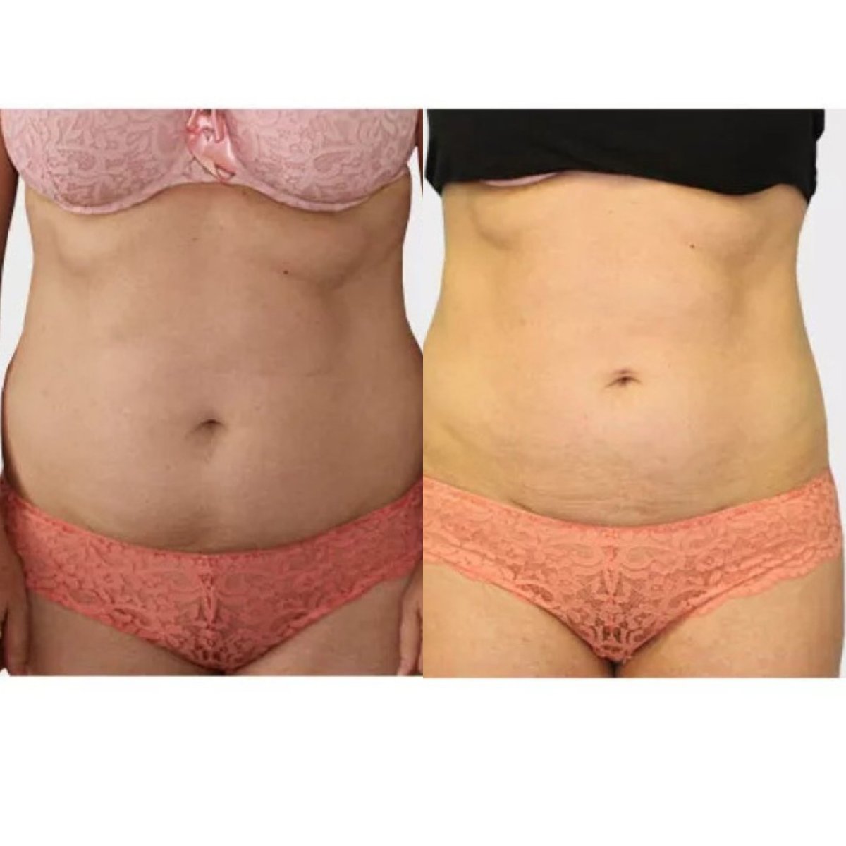 Before and after tumescent liposuction results at Premier Clinic, abdomen contour improvement