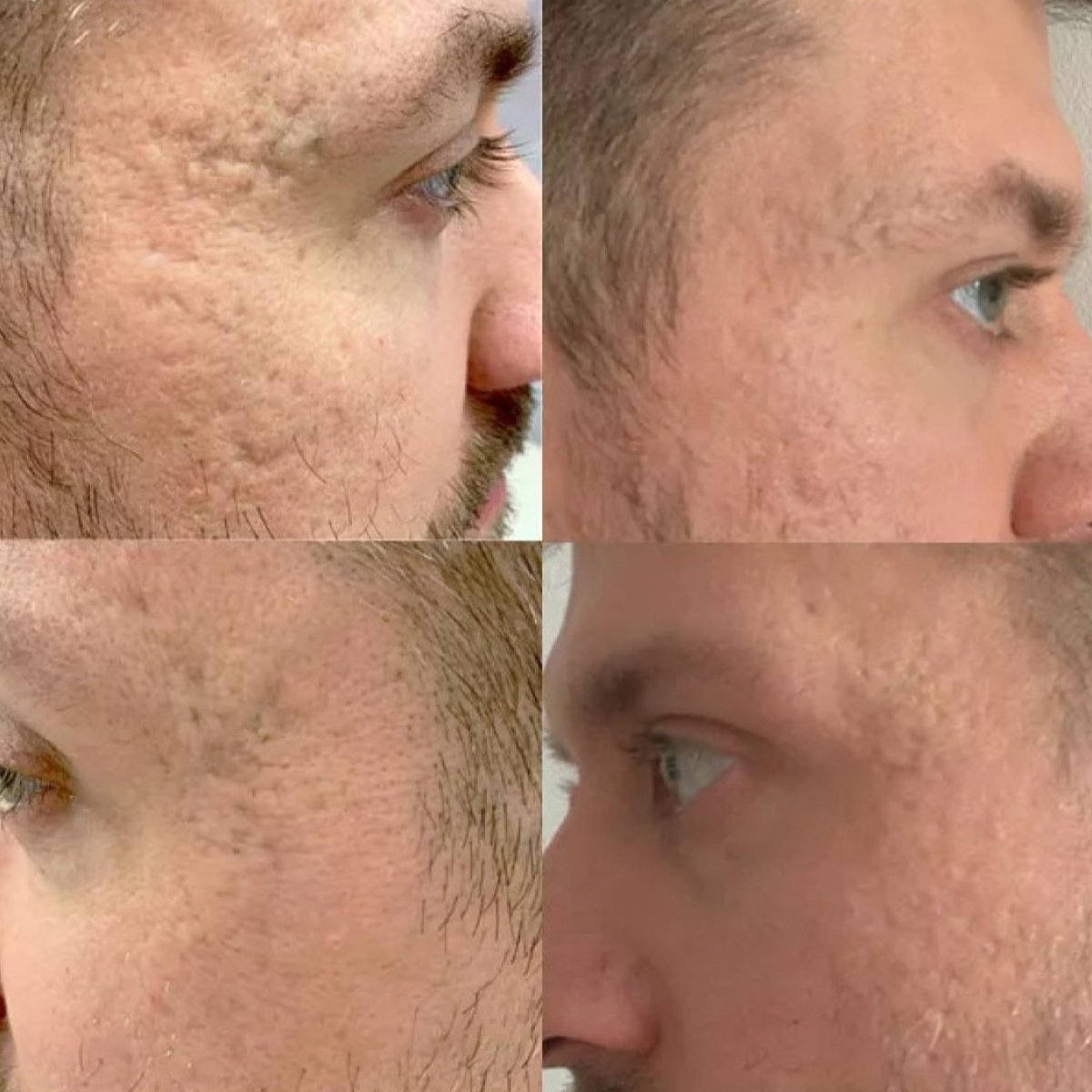 Before and after laser scar removal at Premier Clinic, improved facial skin texture results