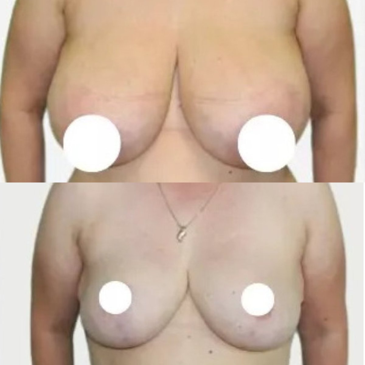 نتائج قبل وبعد تصغير الثدي في Premier Clinic، تحسين شكل وحجم الثدي