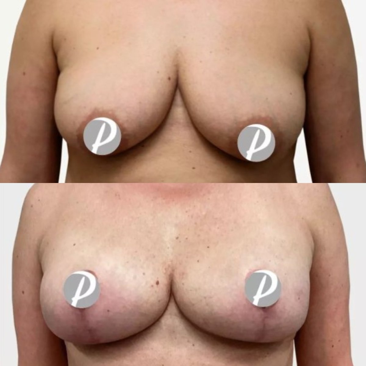 Before and after breast reduction results at Premier Clinic, improved breast shape and lift