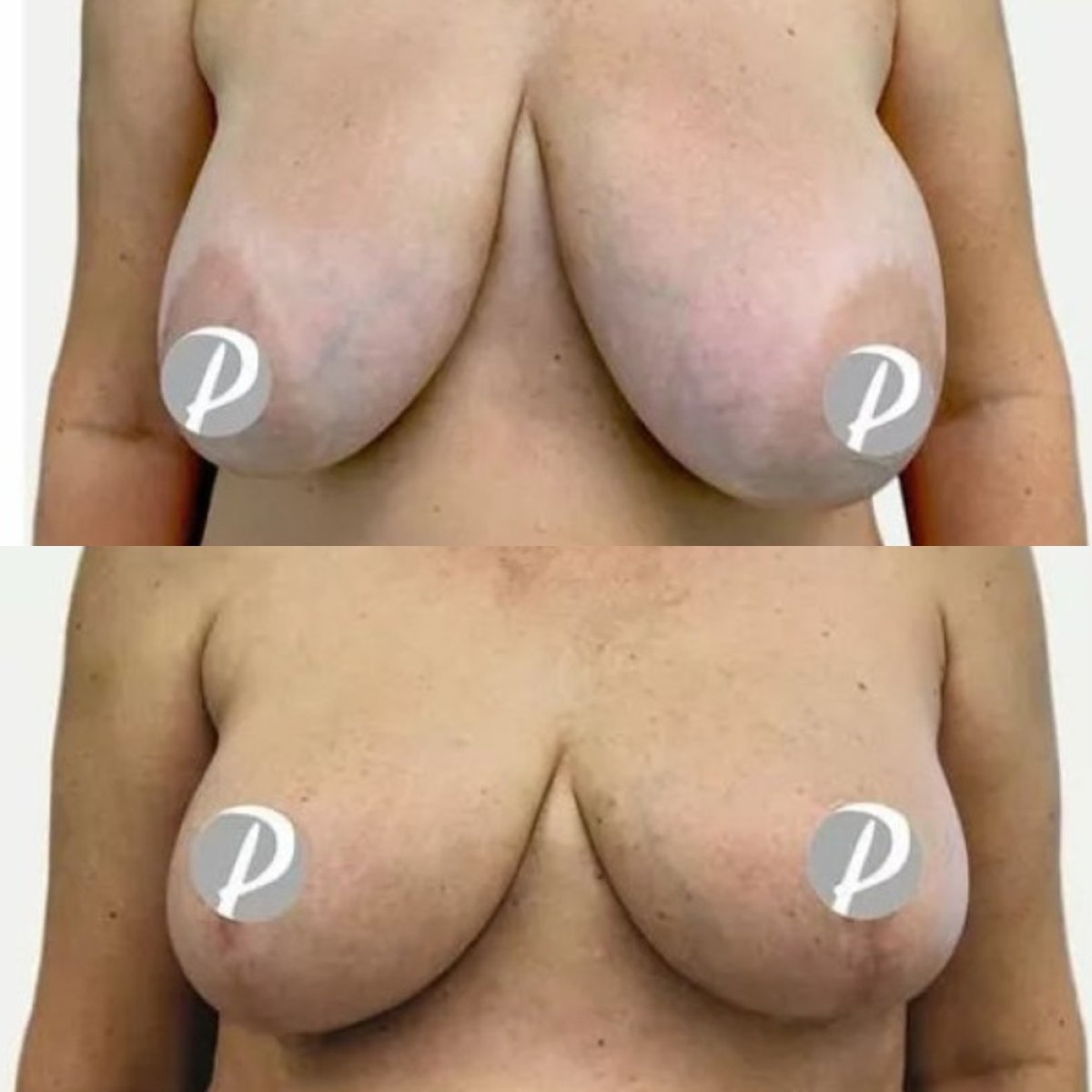 Before and after breast reduction results at Premier Clinic, improved breast shape and lift