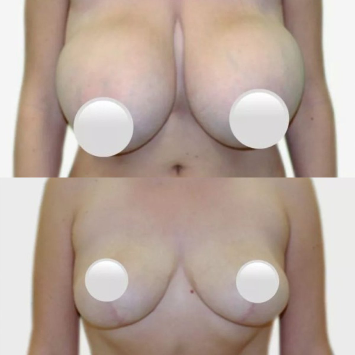 Before and after breast reduction results at Premier Clinic, visible size and shape improvement