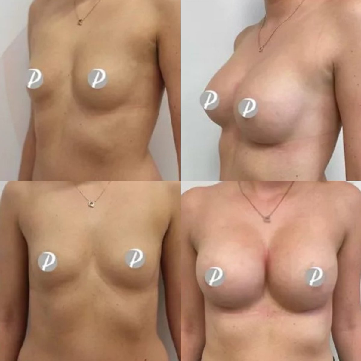 Before and after breast augmentation results at Premier Clinic, enhanced breast volume