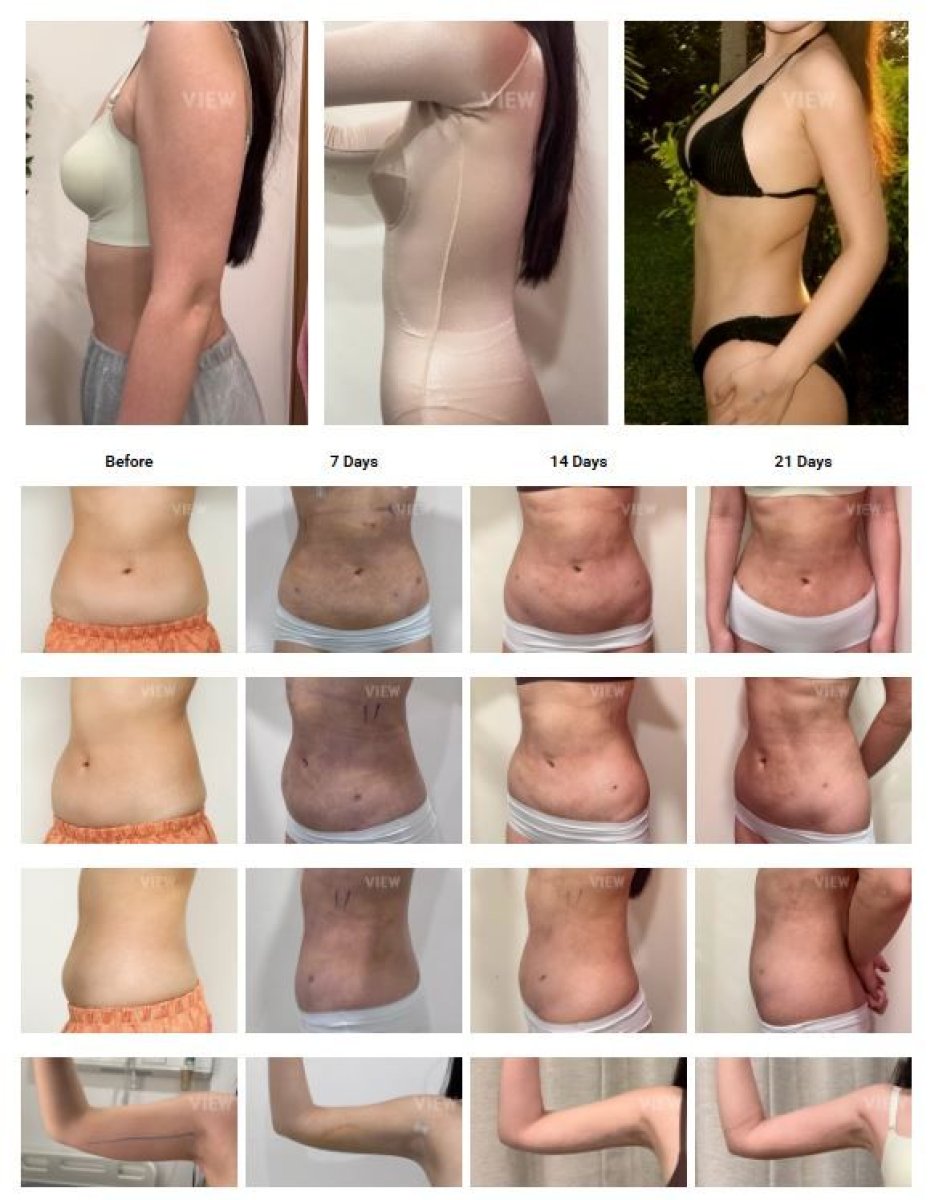 Before and after liposuction results at View Plastic Surgery Hospital, body contour improvement