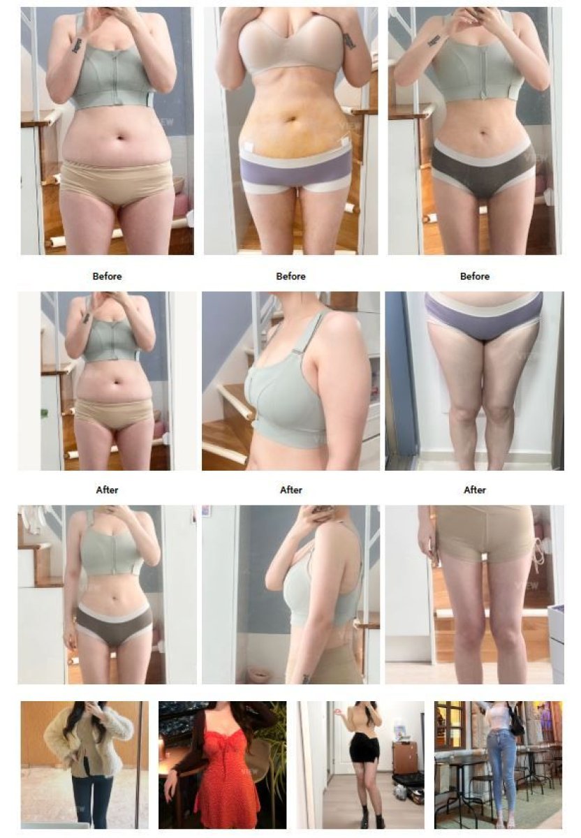 Before and after liposuction results at View Plastic Surgery Hospital – slimmer body contour