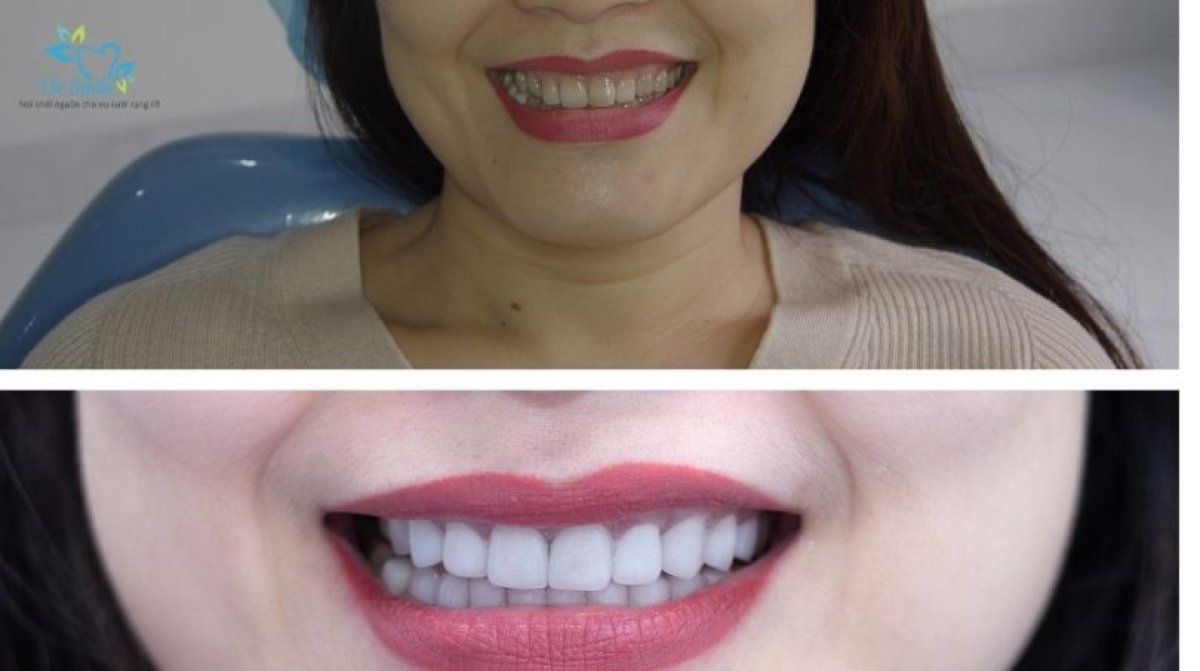 Before and after dental crown installation results at Dr. Smile Dental Clinic, improved smile